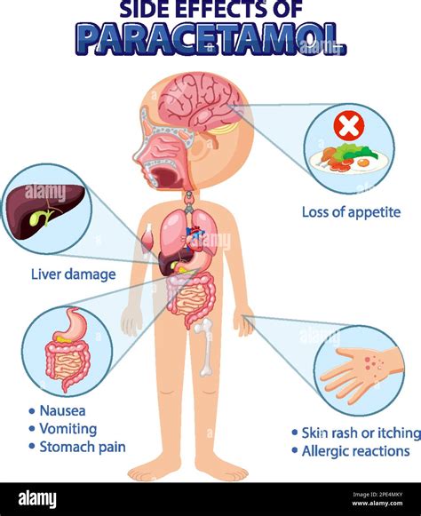 Paracetamol Antidote Side Effects