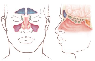 paranasal sinus tumors