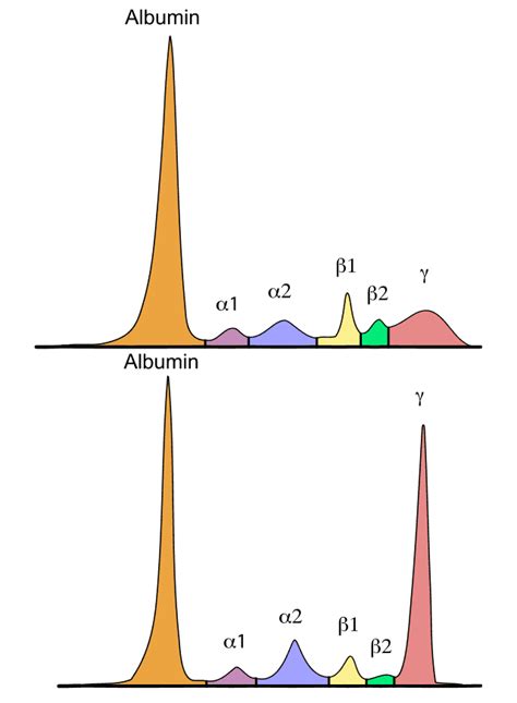 Multiples Myelom Stadium 3 Lebenserwartung Pregnant Center Informations