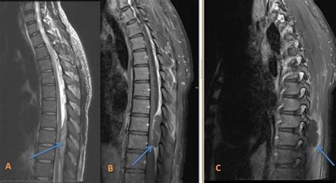 paraspinal abscess icd 10