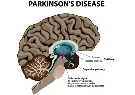 parkinson's affects which part of the brain