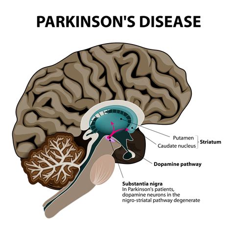 parkinson's and the va