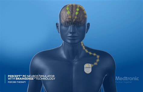 parkinson's deep brain stimulation device