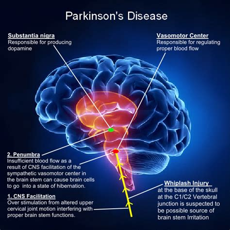 parkinson's disease brain areas affected