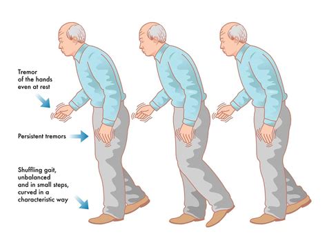 parkinson's disease shuffling gait