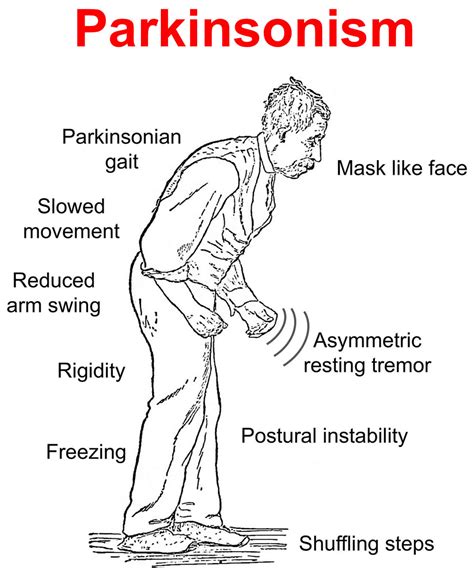 parkinson's disease vs syndrome