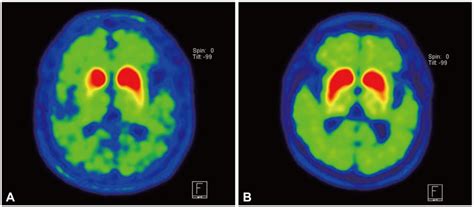 parkinsonism caused by agent orange