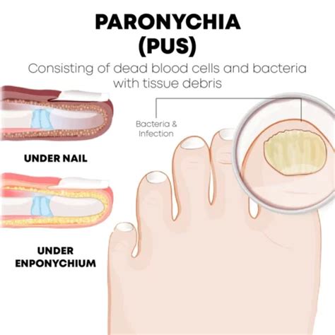 Understanding Paronychia Healing Stages: A Guide to Recovery and Relief