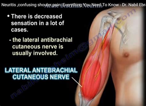 Understanding Parsonage Turner Syndrome: A Rare Nerve Disorder
