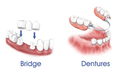 partial bridges for teeth