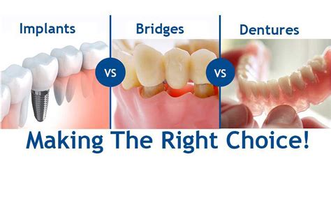 partial dental bridge cost and alternatives