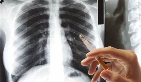 Kondisi Paru-paru Akibat Rokok yang Berlebihan