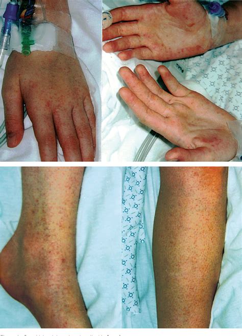 parvovirus b19 arthritis in adults