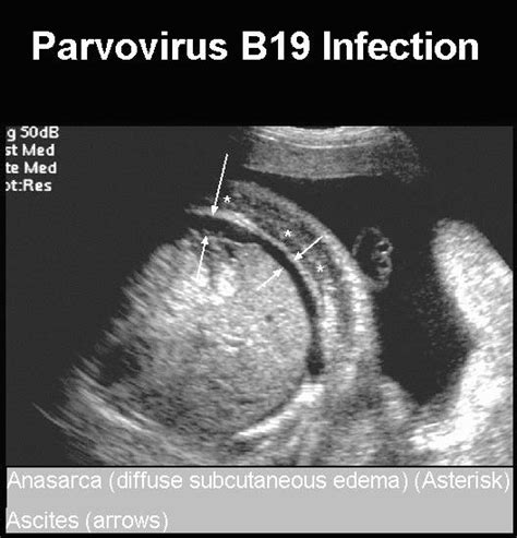 parvovirus b19 diagnostyka