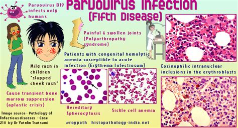 parvovirus b19 fifth disease