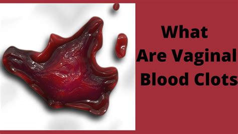 passing clots in miscarriage
