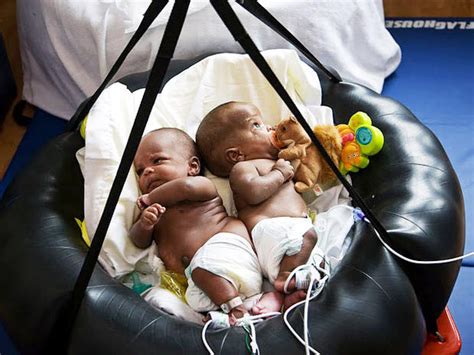 pastor christian moses conjoined twins