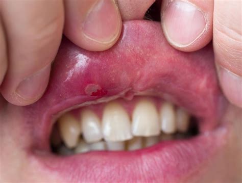 Patches In Upper Mouth