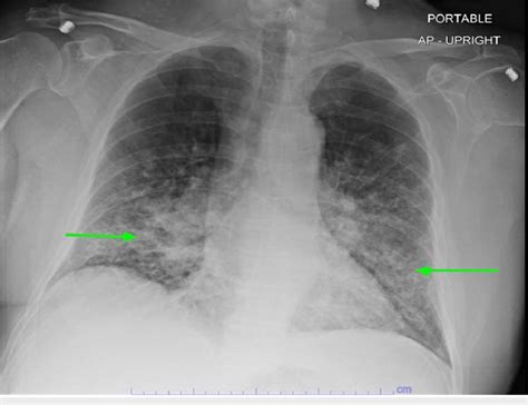 patchy airspace disease lung