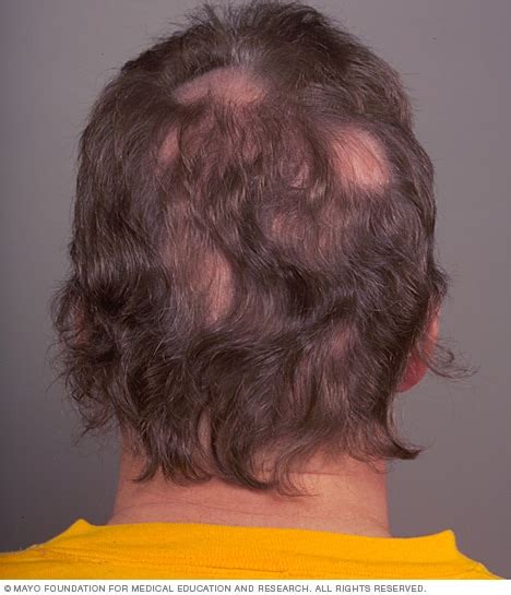 Patchy Hair Loss