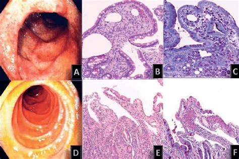 patchy mildly erythematous mucosa