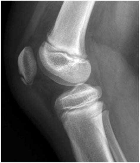 patellar sleeve fracture of left knee icd 10