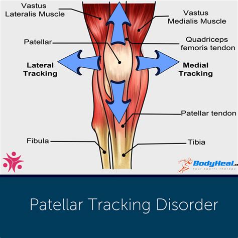 Understanding Patellar Tracking Disorder: Causes and Effective Treatments