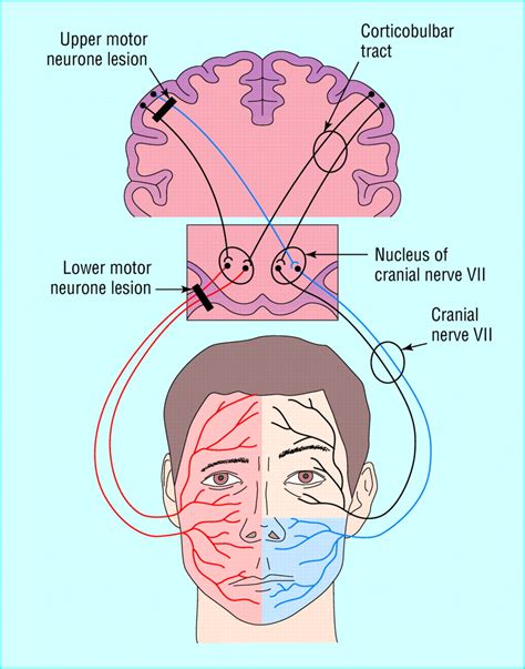 pathophysiology of bell's palsy