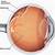 patient info retinal detachment