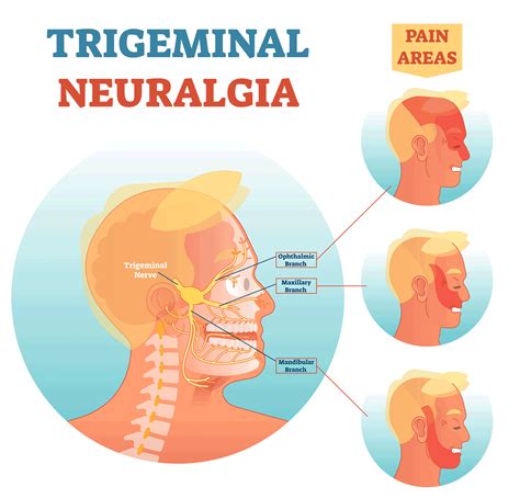 patient info trigeminal neuralgia