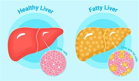 patient uk fatty liver