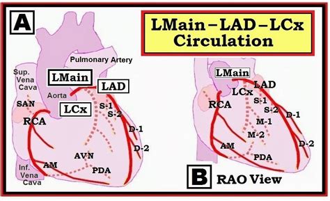 pci to lad med term