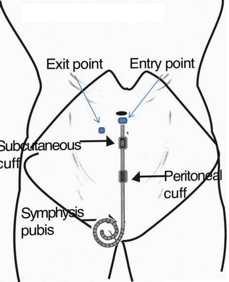 Mastering PD Catheter Placement: Expert Techniques for Improved Patient Outcomes