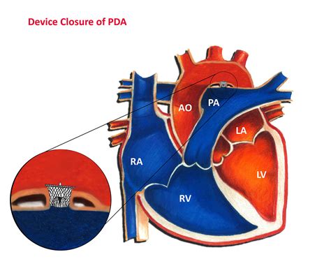 Pda Device Closure Slideshare