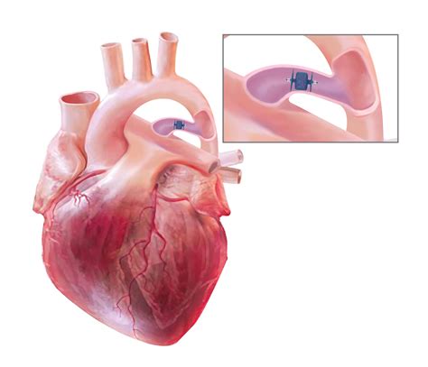 Pda Heart Device