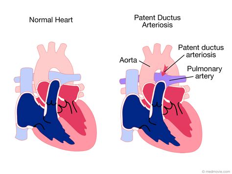 Pda Vs Truncus Arteriosus
