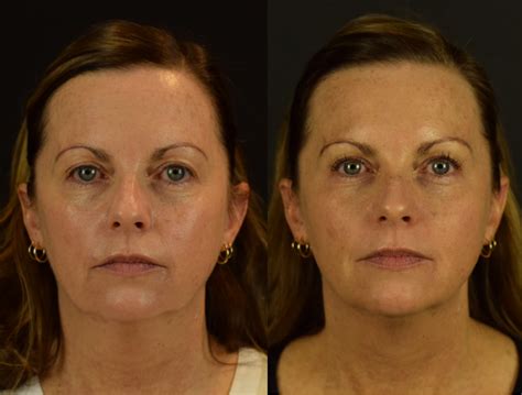 EltaMD UV Clear BroadSpectrum SPF 46 (Tinted) Epi Center MedSpa San