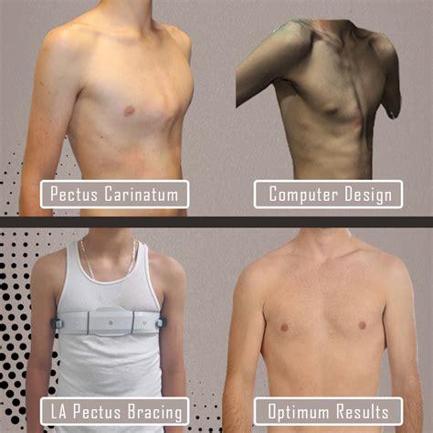 pectus carinatum brace cpt code