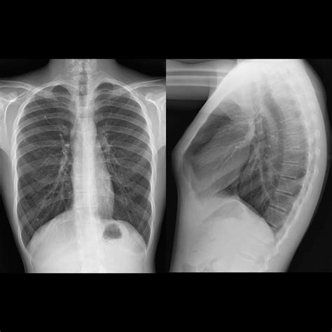 pectus carinatum chest x ray