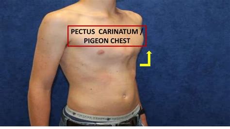 pectus carinatum pigeon chest