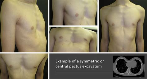 pectus excavatum associated conditions