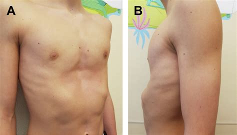 pectus excavatum bar removal