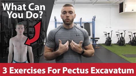 pectus excavatum exercises reddit