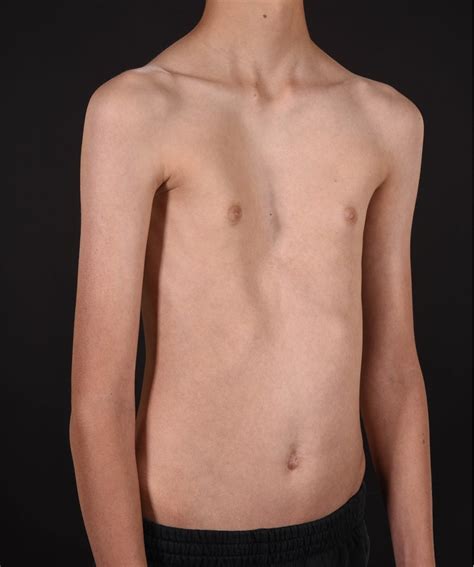 pectus excavatum in children