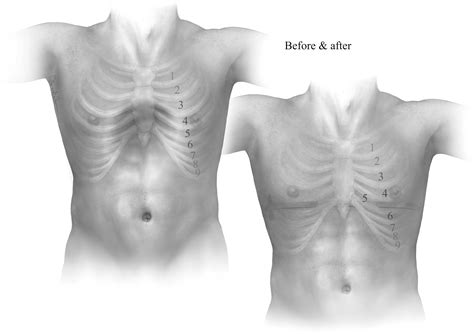 pectus excavatum treatment uk