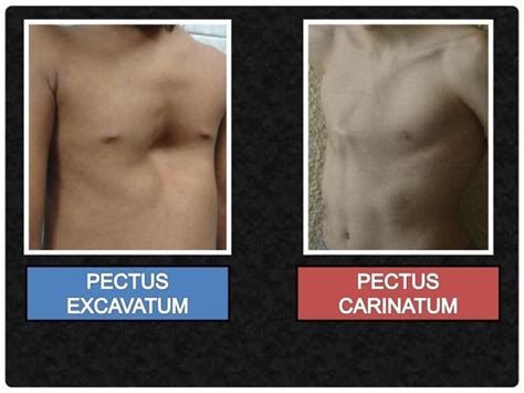 pectus excavatum vs pectus carinatum