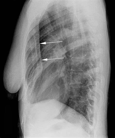 pectus excavatum x ray lateral