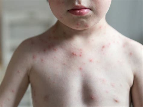 pediatric fever followed by rash