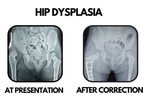 pediatric hip dysplasia surgery