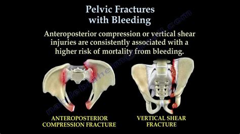 Pelvic Exam Bleeding After